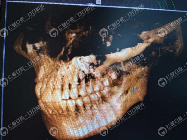 惊!女子智齿重复发炎未在意,面颊被脓肿穿破