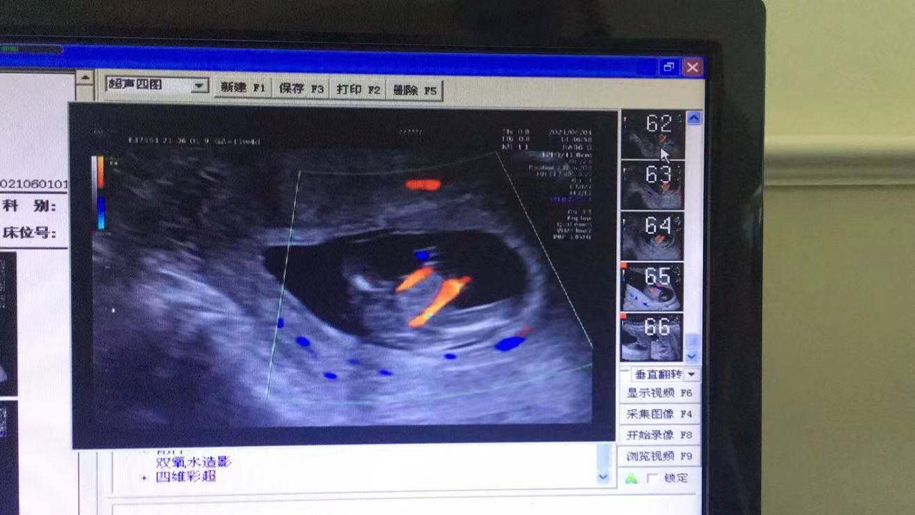 NT筛查出胎儿多发畸形，准妈妈无奈终止妊娠